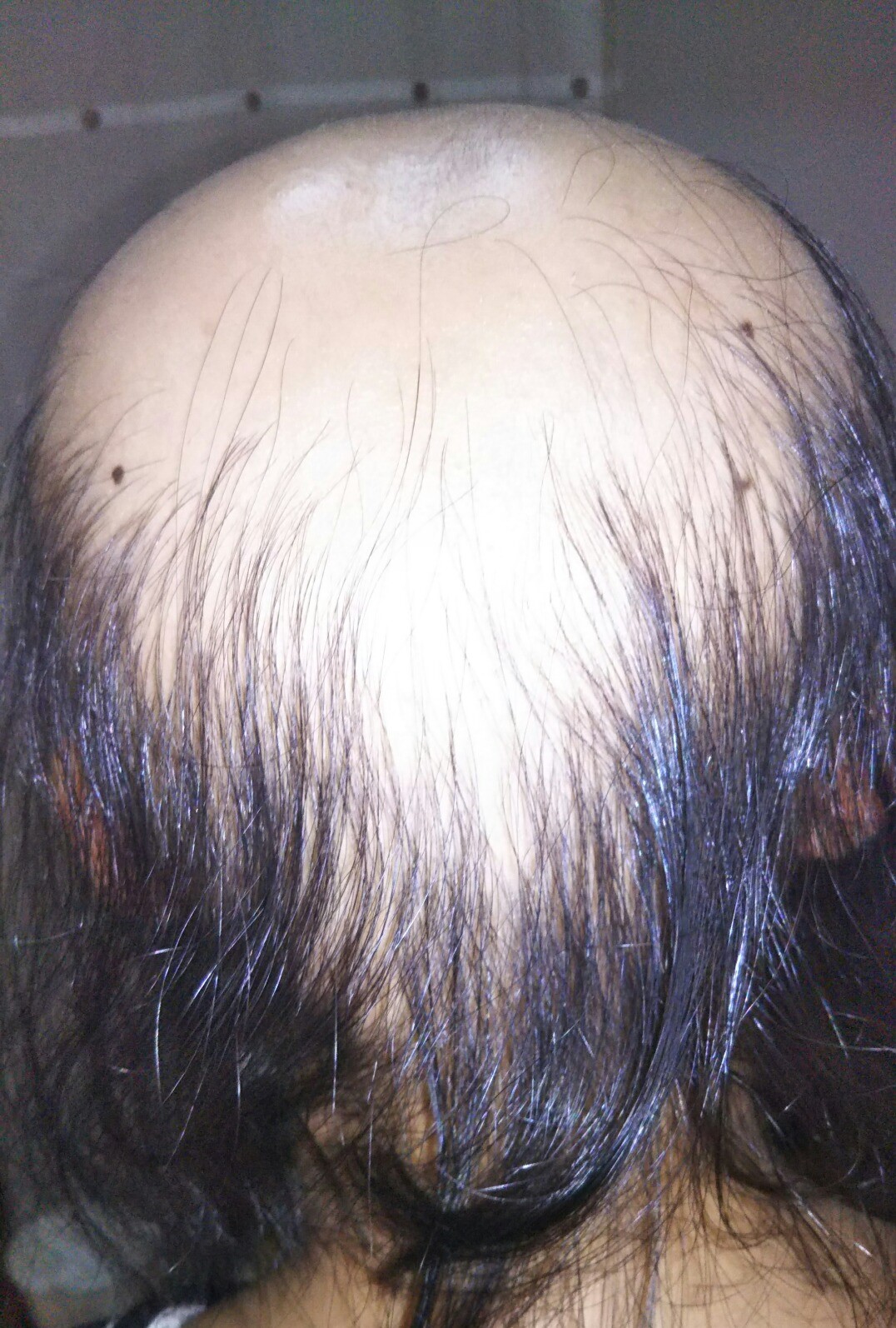 円形脱毛症の症例報告 はる鍼灸治療院 広島市西区